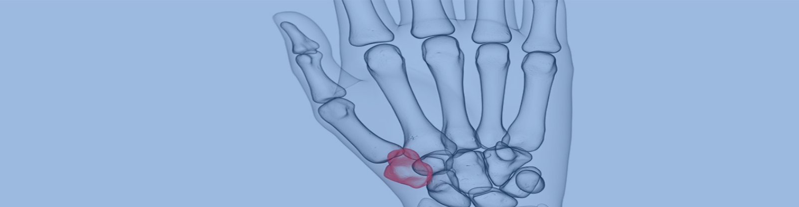 Trapeziectomy